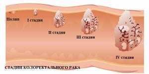 стадии колоректального рака