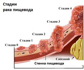 стадии рака пищевода