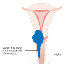 стадии рака шейки матки
