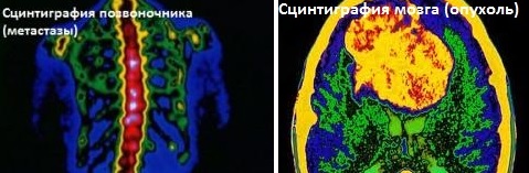 Радионуклидная диагностика рака